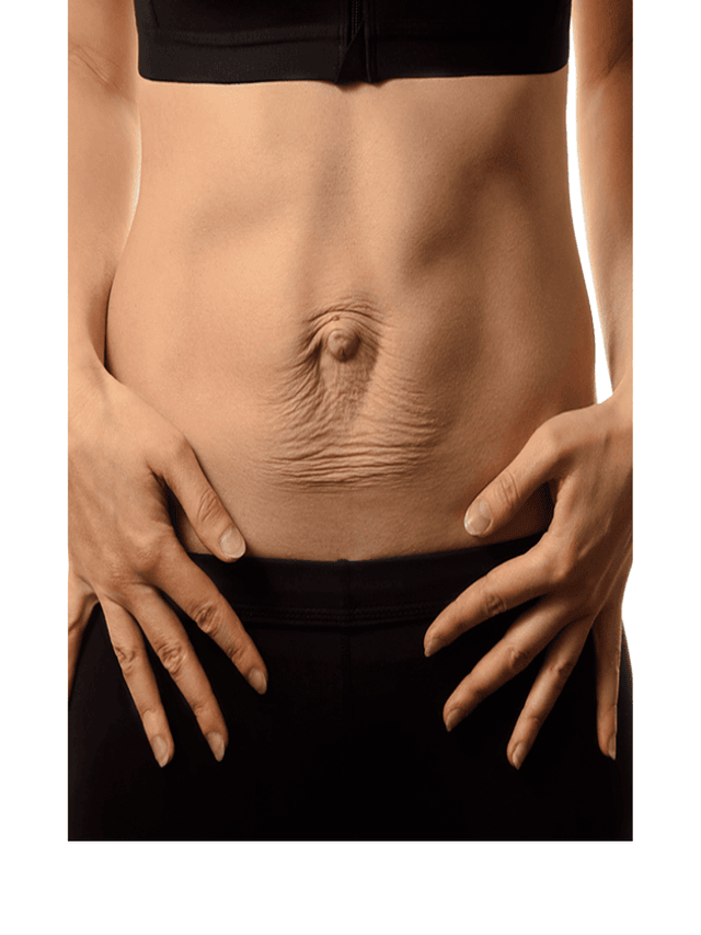 Delivery के बाद Diastasis recti का इलाज कैसे करें